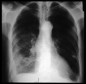 Multifocal Pneumonia