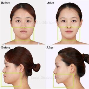 jawline surgery before and after