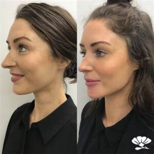 jawline surgery before and after