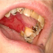 lyme disease teeth