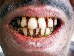 lyme disease teeth